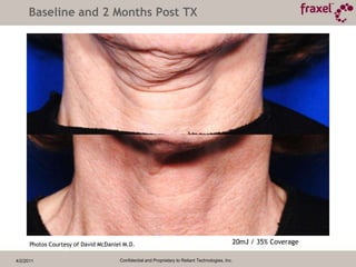 4/2/2011Confidential and Proprietary to Reliant Technologies, Inc.Perioral Region- Pre and 8 Weeks Post Treatment70mJ / 40% CoveragePhotos Courtesy of David McDaniel M.D.