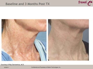 4/2/2011Confidential and Proprietary to Reliant Technologies, Inc.Baseline and 3 Weeks Post TX40mJ / 40% Photographs Courtesy of Nissan Pilest, M.D.