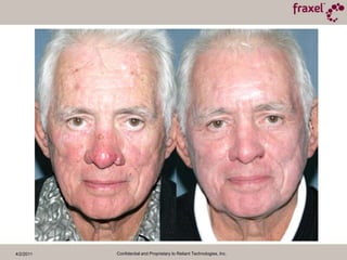 4/2/2011Confidential and Proprietary to Reliant Technologies, Inc.Baseline and 1 Month Post TX30mJ / 30%Photographs Courtesy of Steven R. Cohen, M.D.