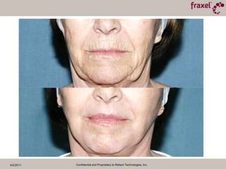 4/2/2011Confidential and Proprietary to Reliant Technologies, Inc.Before and 6 Months Post TXPhotos Courtesy of Steve Weiner, M.D.