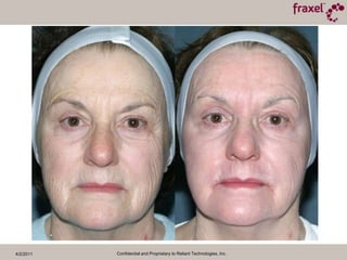 4/2/2011Confidential and Proprietary to Reliant Technologies, Inc.Baseline and 1 Month Post TX40mJ / 40%Photographs Courtesy of Steven R. Cohen, M.D.