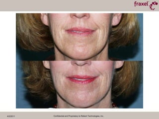 4/2/2011Confidential and Proprietary to Reliant Technologies, Inc.Baseline and 3 Months Post TXCourtesy of Zakia Rahman, M.D.