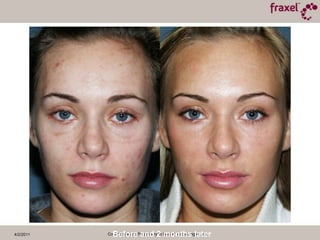 4/2/2011Confidential and Proprietary to Reliant Technologies, Inc.Baseline and 3 Weeks Post TXPeriorbital 30mJ / 35%Cheeks 40mJ /40% Photographs Courtesy of Nissan Pilest, M.D.