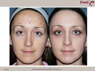 4/2/2011Confidential and Proprietary to Reliant Technologies, Inc.Baseline and 1 Month Post TXPhotograph Courtesy of Richard Fitzpatrick, MD