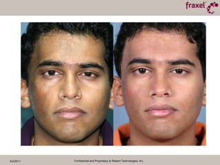 4/2/2011Confidential and Proprietary to Reliant Technologies, Inc.Baseline and 3 Months Post TXCourtesy of Roy Geronemus, M.D. 