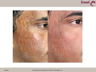 4/2/2011Confidential and Proprietary to Reliant Technologies, Inc.Baseline and 2 Months Post TX20mJ / 35% CoveragePhotos Courtesy of David McDaniel M.D.