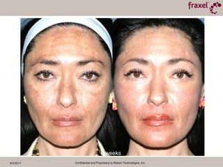 4/2/2011Confidential and Proprietary to Reliant Technologies, Inc.Baseline and 3 Months Post TXCourtesy of Roy Geronemus, M.D.