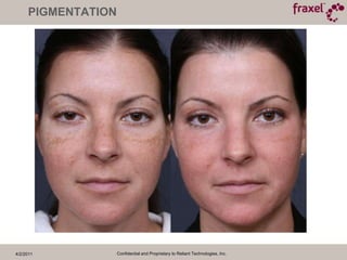 4/2/2011Confidential and Proprietary to Reliant Technologies, Inc.