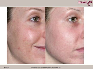 4/2/2011Confidential and Proprietary to Reliant Technologies, Inc.