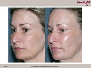 4/2/2011Confidential and Proprietary to Reliant Technologies, Inc.