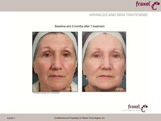 4/2/2011Confidential and Proprietary to Reliant Technologies, Inc.