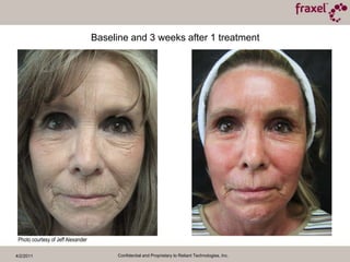 4/2/2011Confidential and Proprietary to Reliant Technologies, Inc.Before and 2 monthslater