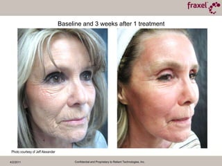 4/2/2011Confidential and Proprietary to Reliant Technologies, Inc.