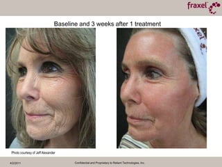 4/2/2011Confidential and Proprietary to Reliant Technologies, Inc.