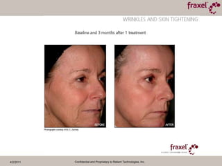 4/2/2011Confidential and Proprietary to Reliant Technologies, Inc.6 weeks