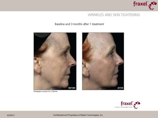 4/2/2011Confidential and Proprietary to Reliant Technologies, Inc.PIGMENTATION