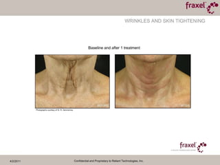 4/2/2011Confidential and Proprietary to Reliant Technologies, Inc.