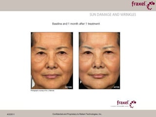 4/2/2011Confidential and Proprietary to Reliant Technologies, Inc.