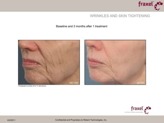 4/2/2011Confidential and Proprietary to Reliant Technologies, Inc.Baseline and 3 weeks after 1 treatmentPhoto courtesy of Jeff Alexander