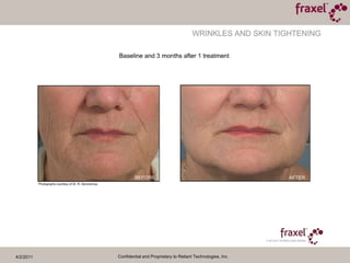 4/2/2011Confidential and Proprietary to Reliant Technologies, Inc.Baseline and 3 weeks after 1 treatmentPhoto courtesy of Jeff Alexander