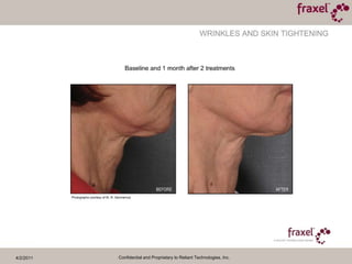 4/2/2011Confidential and Proprietary to Reliant Technologies, Inc.Baseline and 3 weeks after 1 treatmentPhoto courtesy of Jeff Alexander