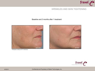 4/2/2011Confidential and Proprietary to Reliant Technologies, Inc.