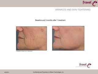 4/2/2011Confidential and Proprietary to Reliant Technologies, Inc.