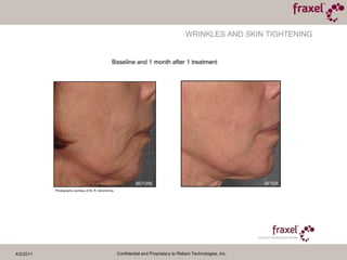 4/2/2011Confidential and Proprietary to Reliant Technologies, Inc.