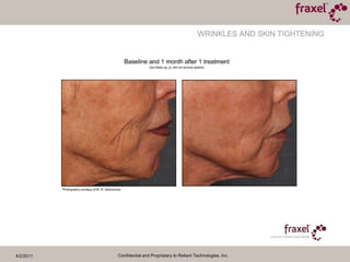 4/2/2011Confidential and Proprietary to Reliant Technologies, Inc.