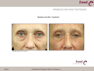 4/2/2011Confidential and Proprietary to Reliant Technologies, Inc.