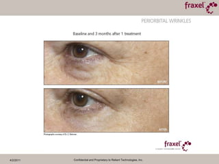 4/2/2011Confidential and Proprietary to Reliant Technologies, Inc.