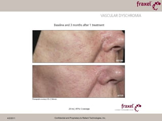 4/2/2011Confidential and Proprietary to Reliant Technologies, Inc.