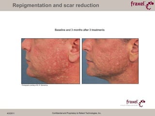 4/2/2011Confidential and Proprietary to Reliant Technologies, Inc.