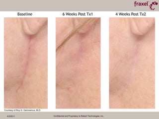 4/2/2011Confidential and Proprietary to Reliant Technologies, Inc.