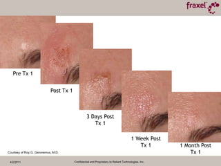 4/2/2011Confidential and Proprietary to Reliant Technologies, Inc.
