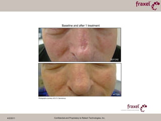 4/2/2011Confidential and Proprietary to Reliant Technologies, Inc.