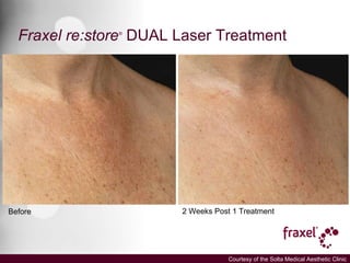 Fraxel Dual La Jolla Cosmetic Laser