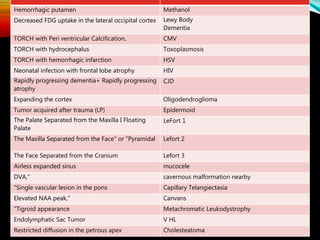 MethanolHemorrhagic putamen
Lewy Body
Dementia
Decreased FDG uptake in the lateral occipital cortex
CMVTORCH with Peri ventricular Calcification,
ToxoplasmosisTORCH with hydrocephalus
HSVTORCH with hemorrhagic infarction
HIVNeonatal infection with frontal lobe atrophy
CJDRapidly progressing dementia+ Rapidly progressing
atrophy
OligodendrogliomaExpanding the cortex
EpidermoidTumor acquired after trauma (LP)
LeFort 1The Palate Separated from the Maxilla I Floating
Palate
Lefort 2The Maxilla Separated from the Face" or "Pyramidal
Lefort 3The Face Separated from the Cranium
mucoceleAirless expanded sinus
cavernous malformation nearbyDVA,"
Capillary Telangiectasia"Single vascular lesion in the pons
CanvansElevated NAA peak,"
Metachromatic Leukodystrophy"Tigroid appearance
V HLEndolymphatic Sac Tumor
CholesteatomaRestricted diffusion in the petrous apex
 
