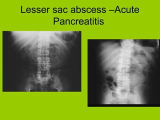 analysis of abdominal x-ray gas. | PPT