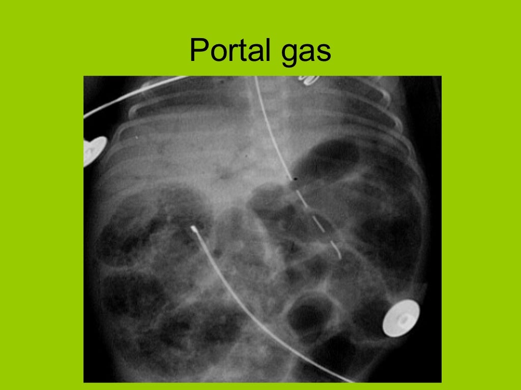 analysis of abdominal xray gas.