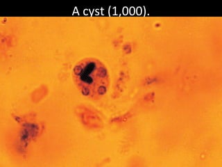 A cyst (1,000).
 