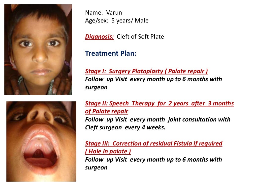 Free Cleft Palate Surgery