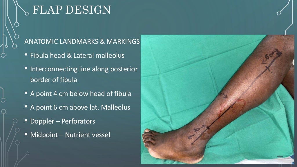 Free fibula flap OMFS 2021 journal club presentation Free fibula flap OMFS 2021 journal club presentation