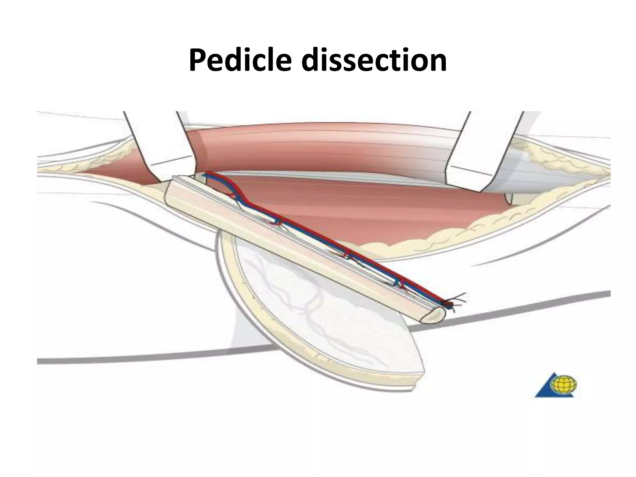 Pedicle dissection
 
