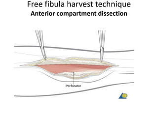 Free fibula harvest technique
Anterior compartment dissection
 