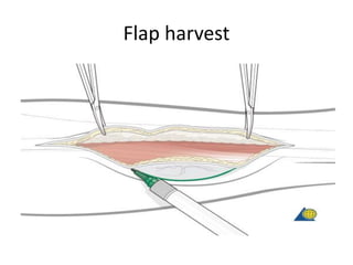 Flap harvest
 