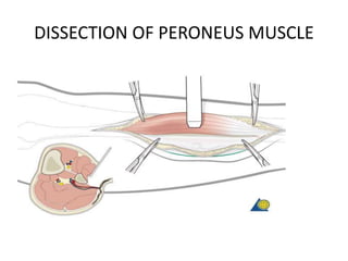 DISSECTION OF PERONEUS MUSCLE
 