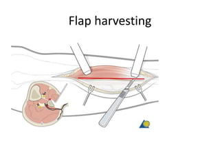 Flap harvesting
 
