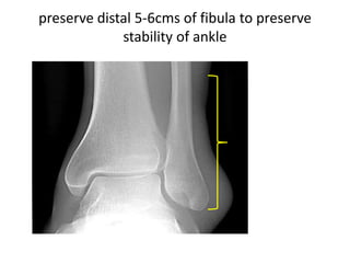 preserve distal 5-6cms of fibula to preserve
stability of ankle
 