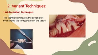 2. Variant Techniques:
• A) Accordion technique:
This technique increases the donor graft
by changing the configuration of the tissue
 
